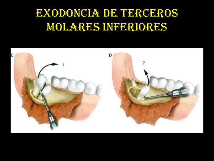 cirugia de terceros molares