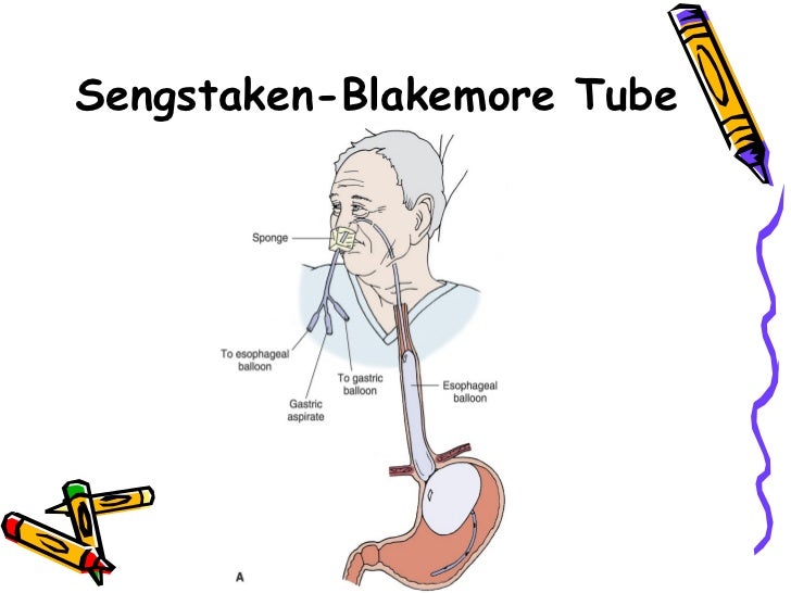 sengstaken blakemore tube