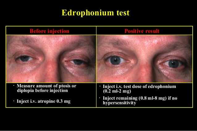 Edrophonium Edrophonium