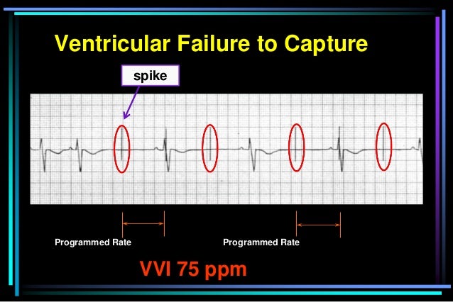 Ventricular Failure to Capture
Programmed Rate Programmed Rate
VVI 75 ppm
spike
 