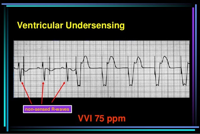non-sensed R-waves
Ventricular Undersensing
VVI 75 ppm
 