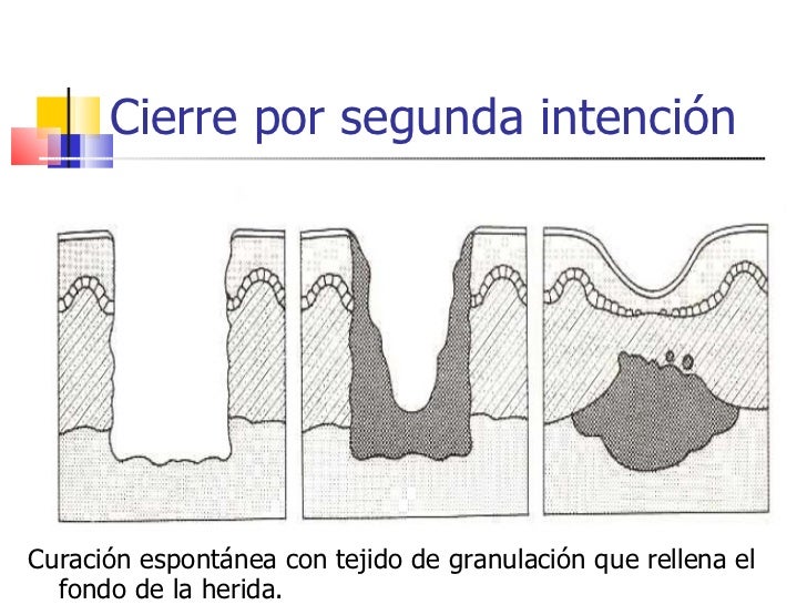 09 nms reparacion de heridas