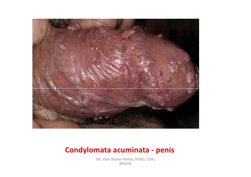 Pics Of Infected Penis 79