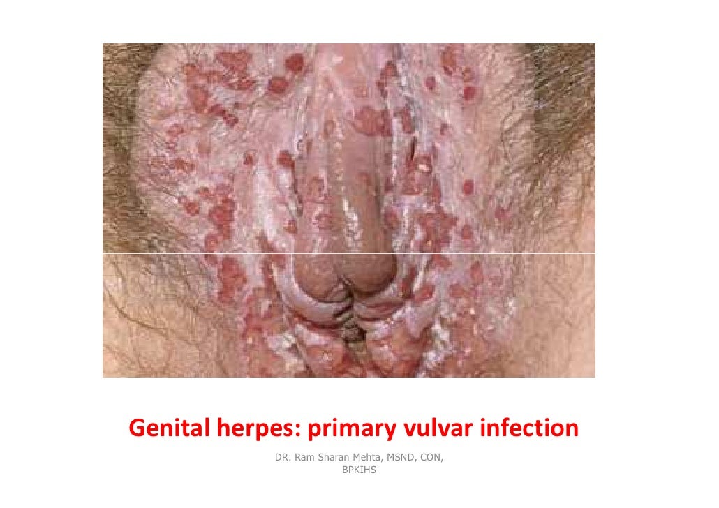 herpetic cold sore