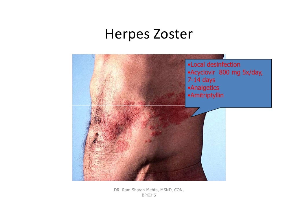 Dating med herpes simplex 2