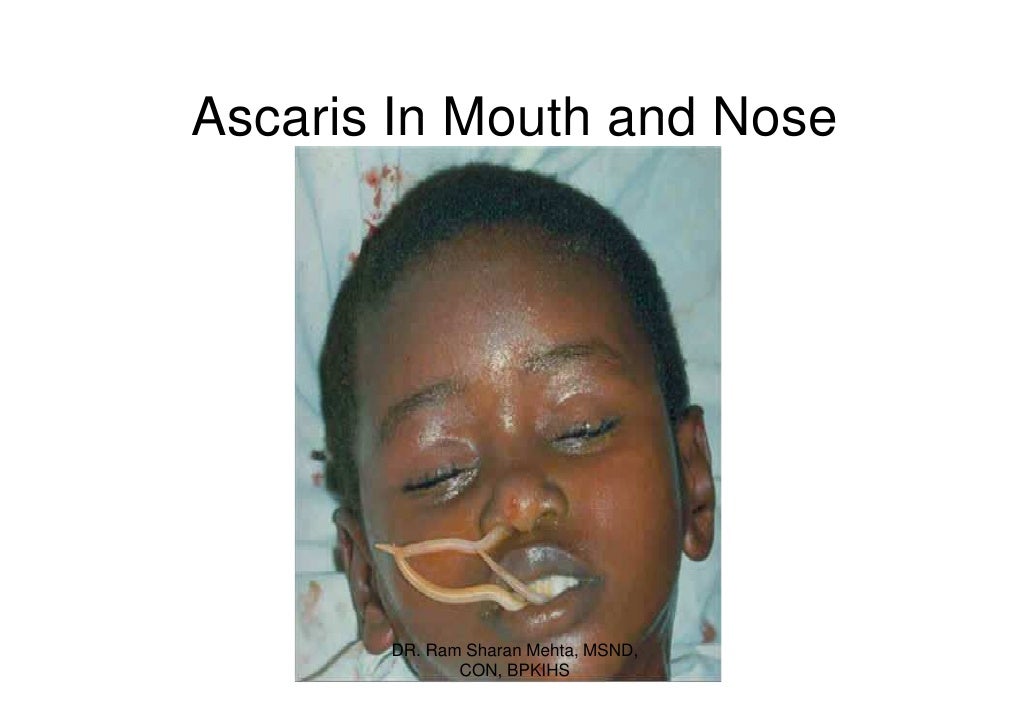 Ascaris In Mouth and Nose DR. Ram Sharan Mehta, MSND, CON, BPKIHS ... - 114-common-paracite-infections-compatibility-mode-14-728