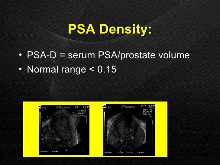 Prostate PSA Vakalis