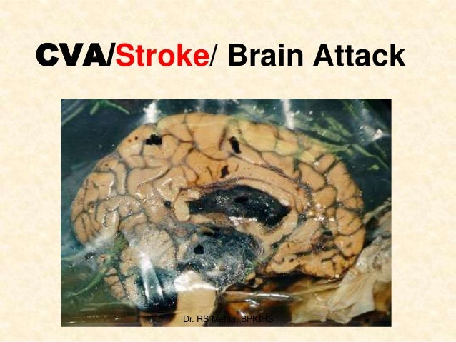 CVA/Stroke/ Brain AttackDr. RS Mehta, BPKIHS CVA/Stroke/ Brain AttackDr. RS Mehta, BPKIHS