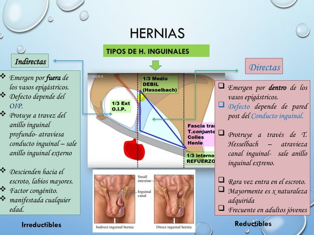 Hernias Abdominales E Inguinales Pptx