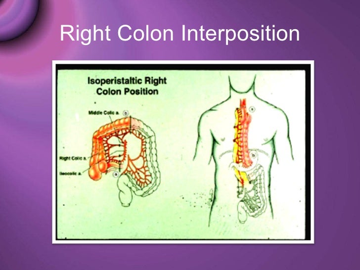 Esophaegeal resection & reconstruction