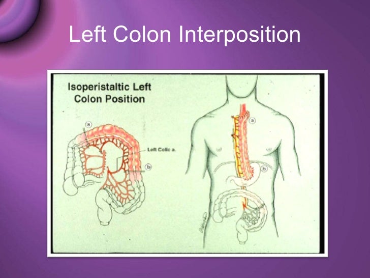 Esophaegeal resection & reconstruction