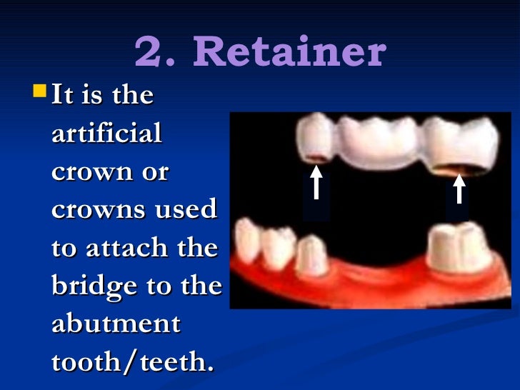 1. fixed partial denture finals1
