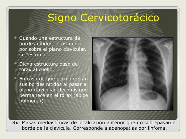 Masa En El Cuello Related Keywords - Masa En El Cuello Masa En El Cuello Related Keywords - Masa En El Cuello