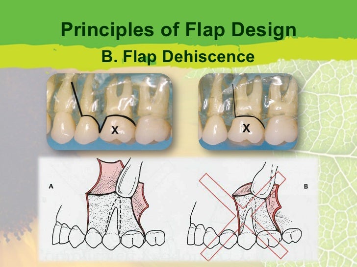 Flap Design for Minor Oral Surgery