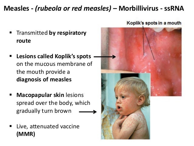 measles rubeola...