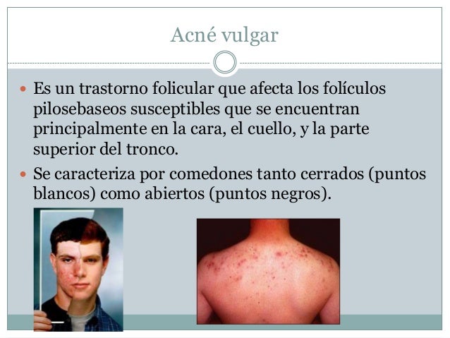 La eccema en las manos como arreglar el picor