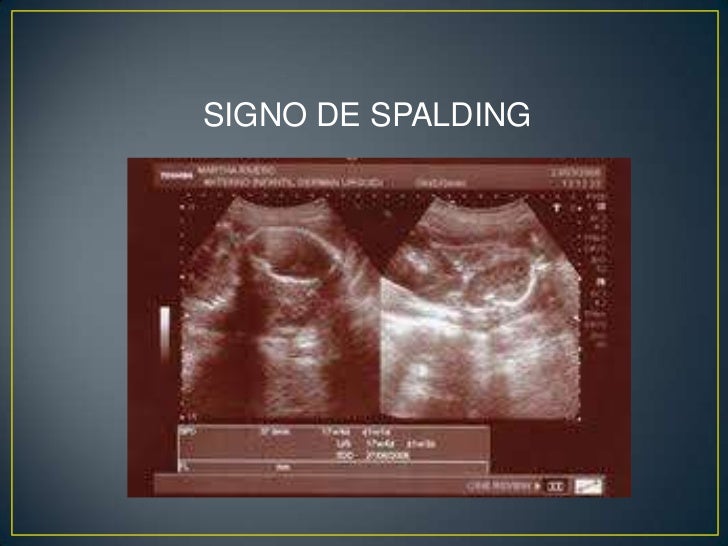 Fetal dating