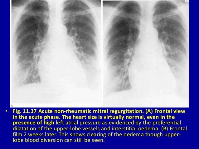 11 acquired heart disease i