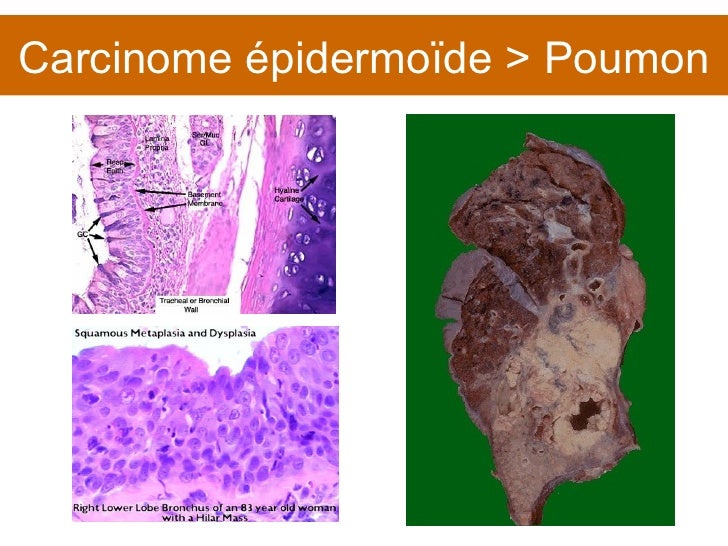 Carcinome Vésiculaire