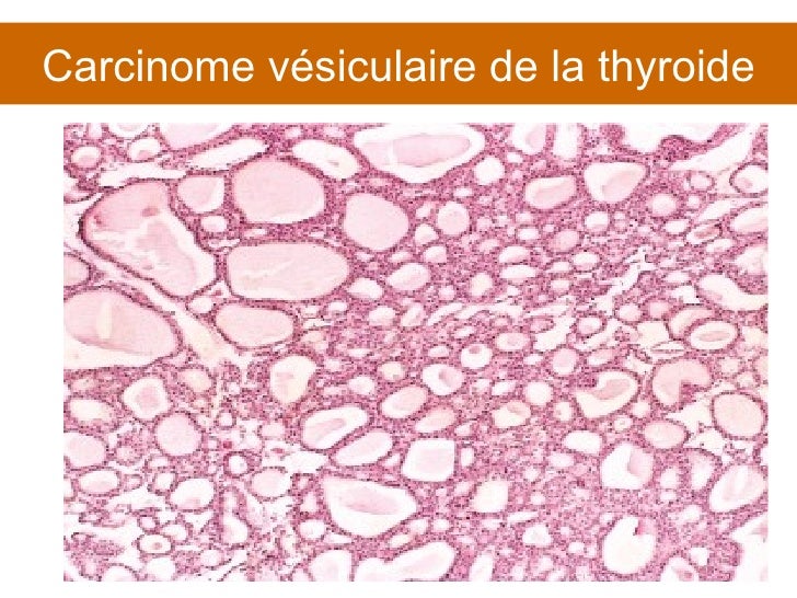 Carcinome Vesiculaire Thyroide
