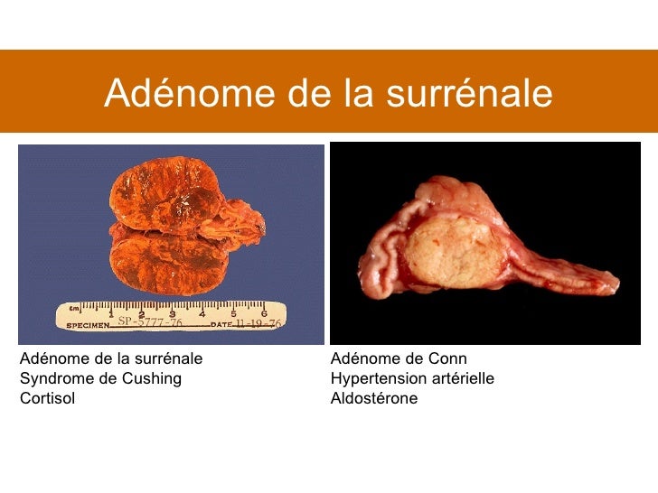 Carcinome Vésiculaire