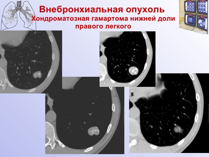 Гамартома лёгкого фото