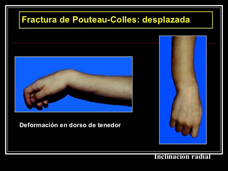 12 Muneca Fracturas