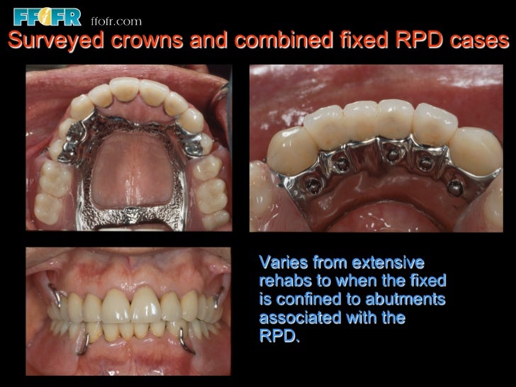 12.surveyed crowns and combined fixed rpd cases