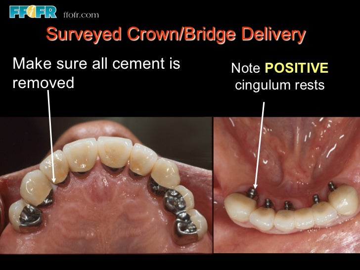 12.surveyed crowns and combined fixed rpd cases