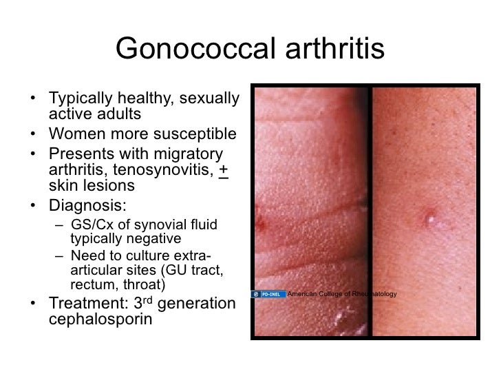 12.02.09(a) Other Inflammatory Arthritides