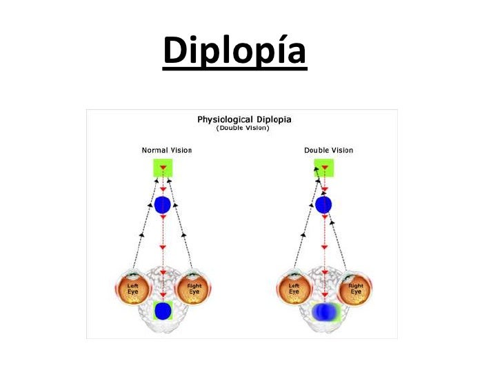 120604 diplopía
