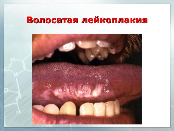 Волосатая лейкоплакия фото