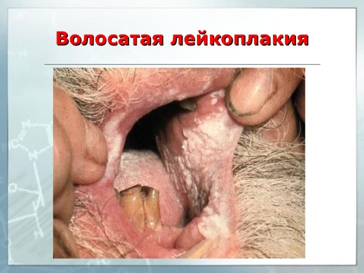 Боли в пояснице отдает по бокам бедра