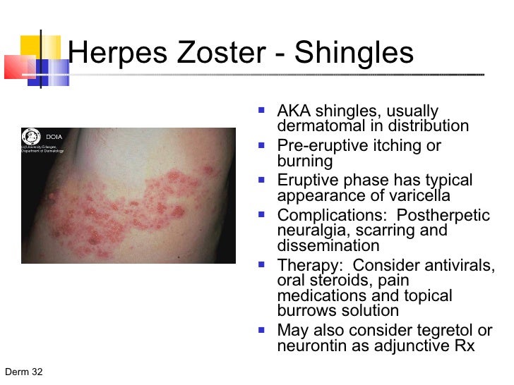essays on shingles-zoster Shingles (herpes zoster) is a painful skin rash caused by varicella zoster, the same virus that causes chickenpox once you've had chickenpox, the virus remains in your body in a dormant or inactive stage if the virus becomes active again you may get shingles age, increased stress, and problems. essays on shingles-zoster Shingles (herpes zoster) is a painful skin rash caused by varicella zoster, the same virus that causes chickenpox once you've had chickenpox, the virus remains in your body in a dormant or inactive stage if the virus becomes active again you may get shingles age, increased stress, and problems.
