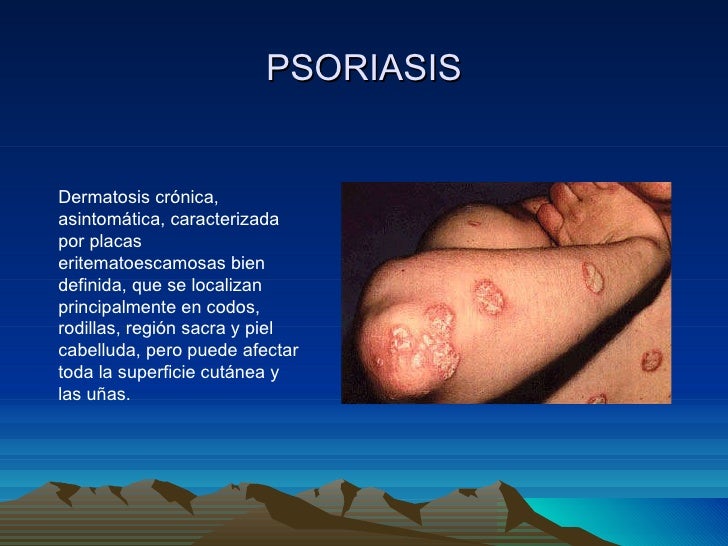 Curar el dolor a la psoriasis de las articulaciones