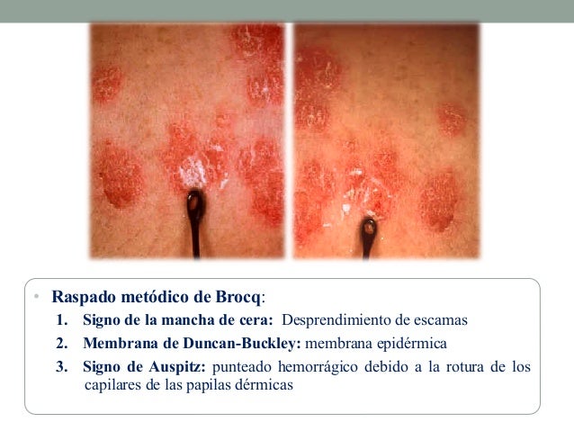 Las vitaminas en las cápsulas a la psoriasis