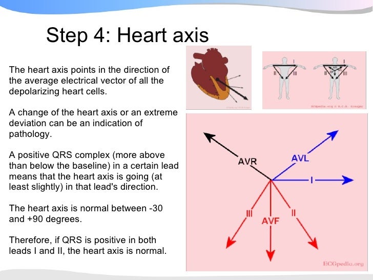 ECGpedia ECG Presentation