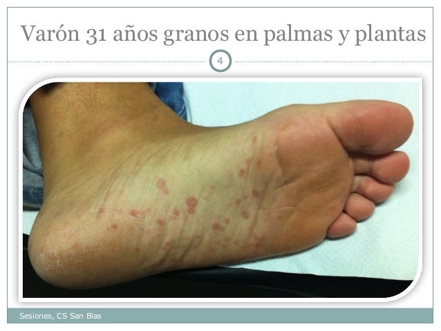 La psoriasis y los suicidios