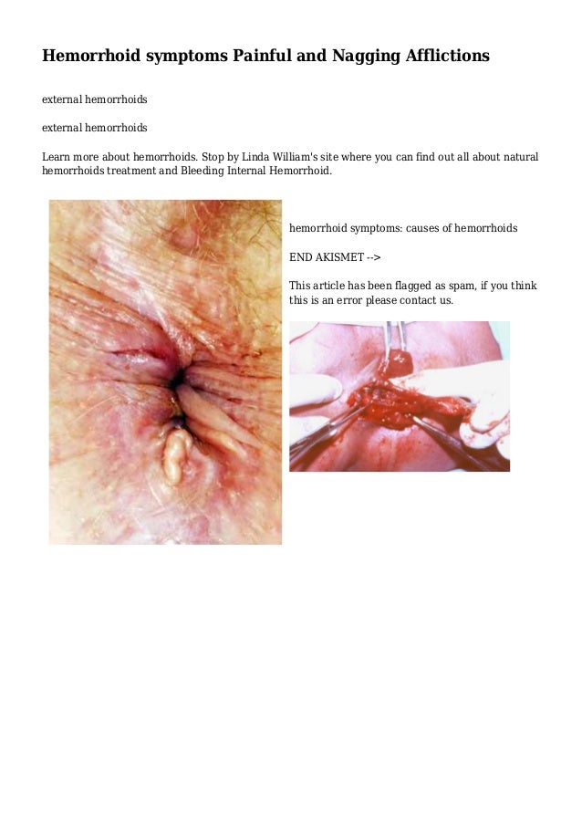 hemorrhoids while pregnant