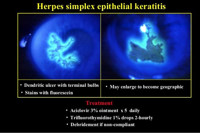Herpes simplx treatment