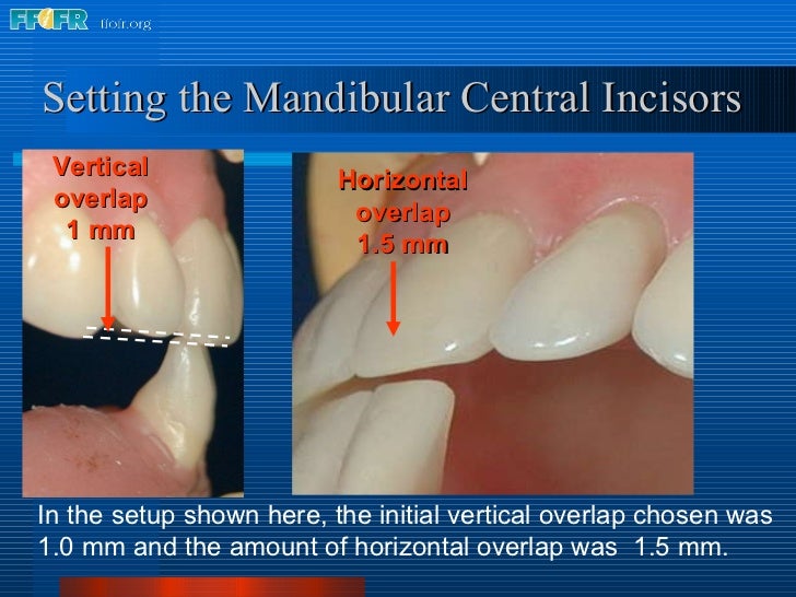 16.occlusal schemes lingualized occlusion