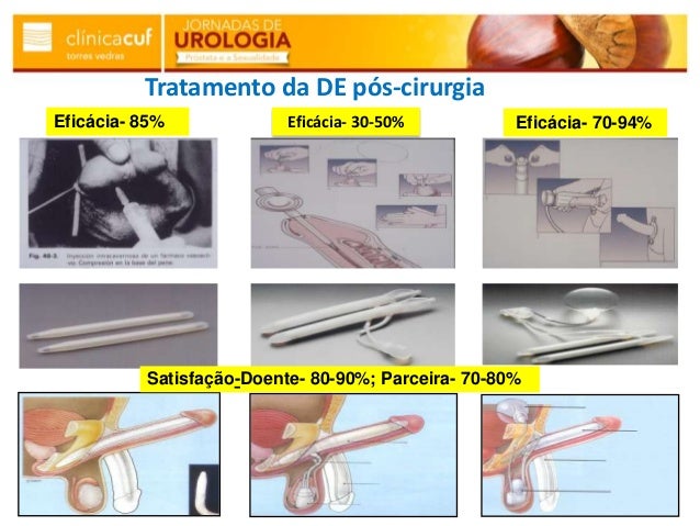Cialis E Prostatite