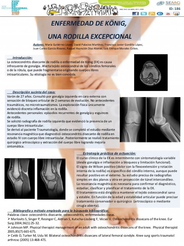 186 ENFERMEDAD DE K NIG UNA RODILLA EXCEPCIONAL 186-enfermedad-de-k-nig-una-rodilla-excepcional