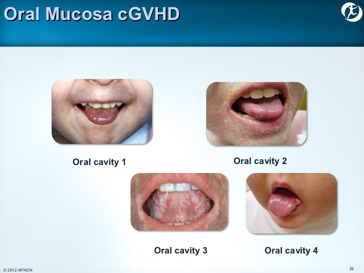 19 chronic20 gvhd[1]