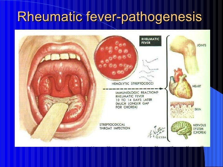 Rheumatic Fever: Background, Pathophysiology, Epidemiology