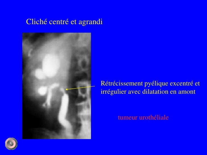 Tumeur Ureterale