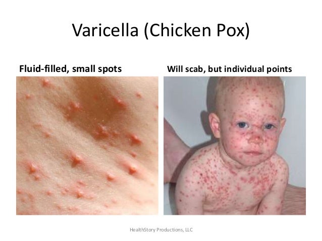 Chickenpox (Varicella) Symptoms, Treatment, Causes - What ...