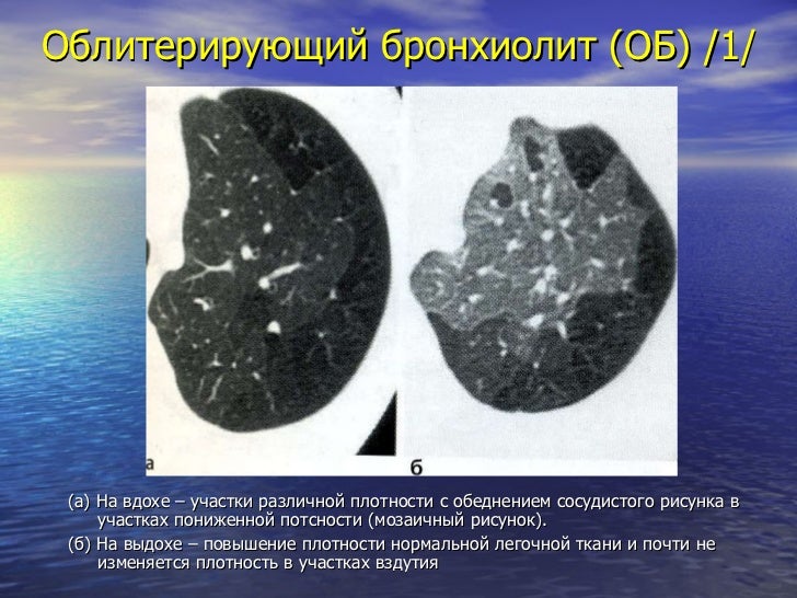 Бронхиолит фото