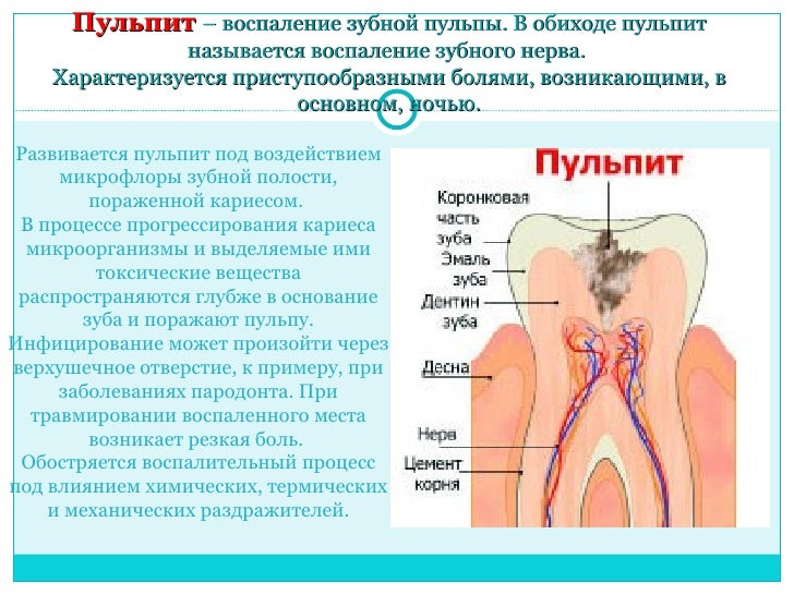 Воспален нерв на десне Воспален нерв на десне