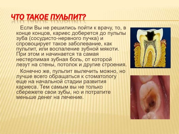 Что такое пульпит зуба как его лечат Что такое пульпит зуба как его лечат